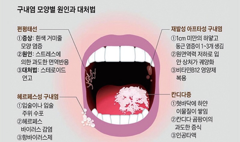 구내염 모양별 원인과 대처법.jpg